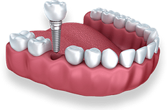 Dental implant model showing tooth replacement procedure with crown and implant fixture in gum.