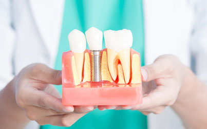 Dentist holding dental implant model showing tooth structure and placement procedure.