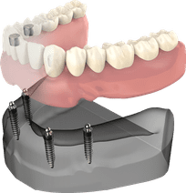 Dental implant model showing prosthetic teeth attachment to jawbone structure.