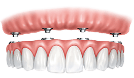 Dental implant bridge model showing pink gum tissue above white replacement teeth prosthetic.